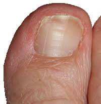 auckland ingrown toenail clinic