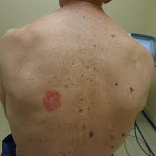 skin cancer symptoms pictures photos