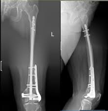 distal fem fractures a comparison