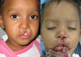 cleft lip palate repair before and