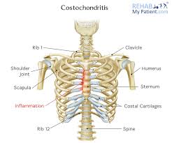 The thoracic cage consists of the 12 thoracic vertebrae, the associated intervertebral discs, 12 pairs of ribs with their costal cartilages, and the sternum. Costochondritis Rehab My Patient
