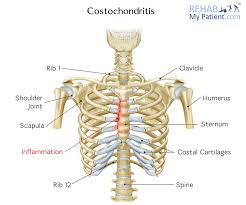 costochondritis rehab my patient