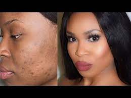 how to cover scars and dark spots