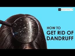 how to get rid of dandruff easy tips