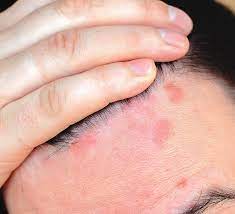 red spots on scalp pictures causes