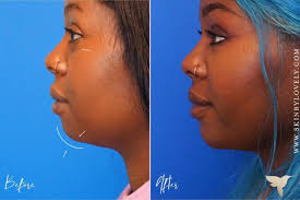 dermal fillers with before after