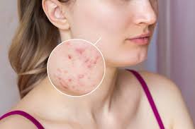 can morpheus8 treat acne scars skin