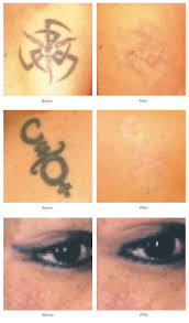 botox laser hair removal mole removal