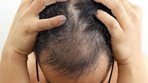 what causes stress alopecia and how can