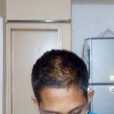 Soon, he was wearing hats all day. 16 Year Old Boy Is Growing Bald What Can Be Done Should I Consult A Doctor At 16 Are Medicines Like Rogain Safe Photo