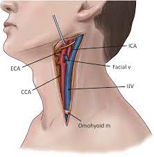 This article shall explore the arterial supply to these areas. Carotid Artery And Internal Jugular Vein Injuries Chapter 8 Atlas Of Surgical Techniques In Trauma