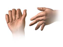 hand rheumatoid arthritis physiopedia