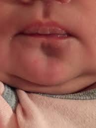 possible blisters on baby s lips pic