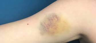 great tips for treating bruises