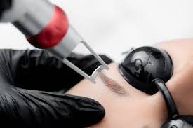 laser tattoo removal for eyebrows