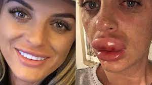 top lip after getting botched fillers