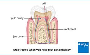 Average cost of dental insurance that covers dentures. Root Canal Treatment Endodontists Bupa Dental Care Uk