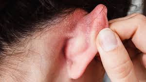 why you get dry skin behind your ears