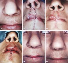 abbe flap in secondary cleft lip repair