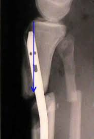 im nailing of proximal tibial fractures