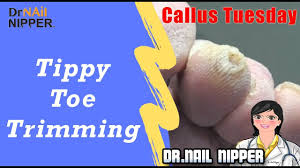 toe callus where is your tippy toe
