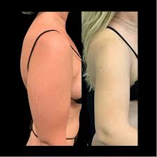 before after arms liposuction