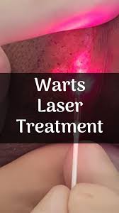 warts removal by simple laser ablation