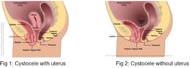 pelvic floor repair anterior and