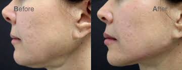 Learn more and view jawline contouring before and afters at deep blue med spa in garden. Filler Treatment For Jawline Correction At Rs 19000 Box à¤¬ à¤Ÿ à¤• à¤¸ à¤Ÿ à¤° à¤Ÿà¤® à¤Ÿ à¤¬ à¤Ÿ à¤• à¤¸ à¤‰à¤ªà¤š à¤° Skin Whitening Injections Elegance Perfect Beauty Company Chennai Id 20711287891