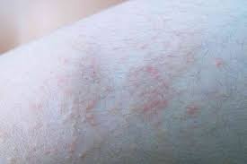 rash from caterpillar symptoms