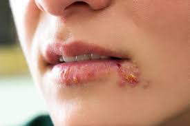 herpes treatment by specialist