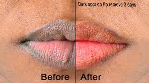 dark spot on lip remove 3 days