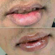 permanent lip colour tattoo at rs 15000