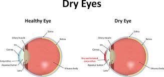 dry eyes eye care surgery center