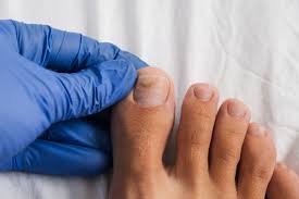fungal toenail treatment