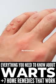 how to get rid of warts at home 7 tips