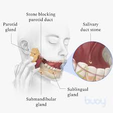 salivary duct stones symptoms causes