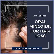 minoxidil for hair loss the