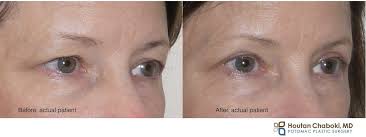 cosmetic upper eyelid surgery may