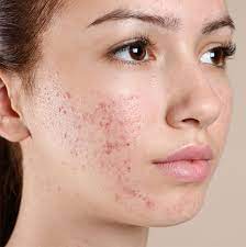 acne and acne scarring treatments