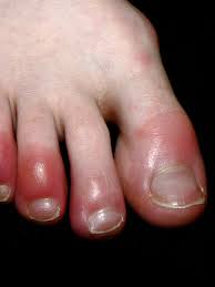 mysterious wave of covid toes still has