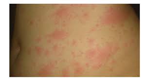 They can also be caused by bacterial, fungal, viral, or parasitic infections. Skin Changes Due To Covid 19 Infections In Children Clinical Health Care Radius