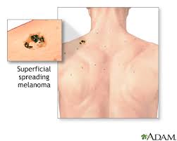melanoma medlineplus cal encyclopedia