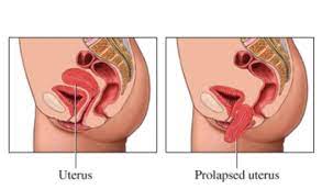pelvic organ prolapse global women