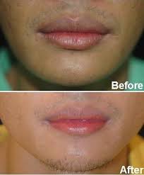 dark lips yoskarn clinic plastic