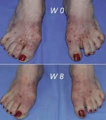foot allergic contact dermais