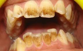 How to remove coffee stains from teeth. How To Remove Coffee Stains From Teeth Teethwalls