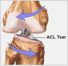 acl knee injury causes symptoms