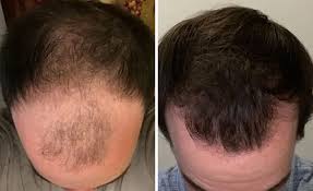 people who tried out hair loss