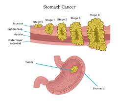 stomach cancer symptoms causes
